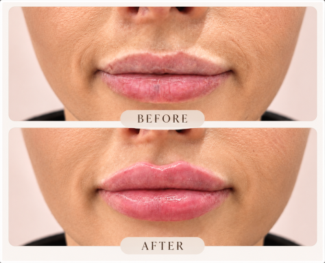 Lip Filler Treatments | Oakleigh Glow Aesthetics Close-up of naturally enhanced lips showing definition and volume following a lip filler treatment.