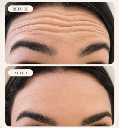 Anti-Wrinkle Injections | Oakleigh Glow Aesthetics Before and after forehead anti-wrinkle treatment showing visibly softened lines at Oakleigh Glow Aesthetics.