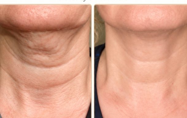 Profhilo Skin Rejuvenation | Oakleigh Glow Aesthetics Woman with radiant skin alongside Profhilo injectable skin treatment product for skin rejuvenation.