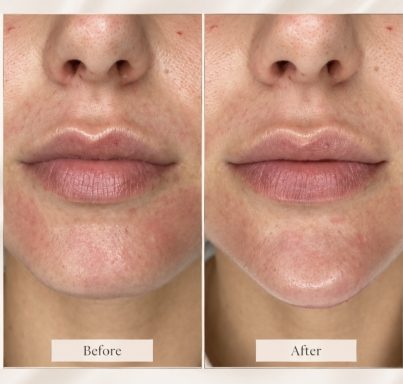 Dermal Filler Treatments | Oakleigh Glow Aesthetics Before and after dermal filler treatment showing enhanced facial contours and definition.
