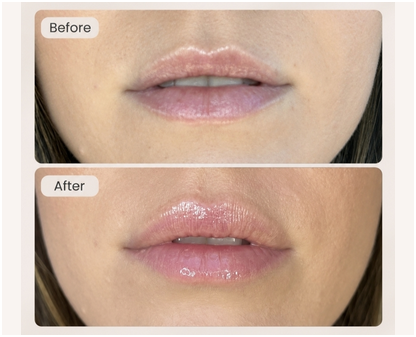 Hydrating Lip Booster | Oakleigh Glow Aesthetics Close-up of naturally hydrated, glossy lips following a lip hydration booster treatment.