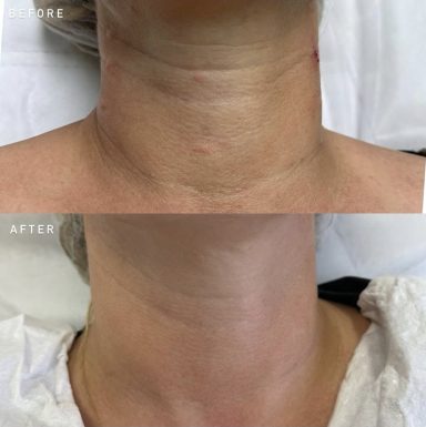 Polynucleotide Treatments | Oakleigh Glow Aesthetics Polynucleotide skin rejuvenation injection being administered to the facial area by an aesthetic practitioner.