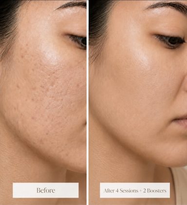Microneedling & Skin Rejuvenation | Oakleigh Glow Aesthetics Microneedling facial treatment to stimulate collagen production and improve skin texture at Oakleigh Glow Aesthetics.